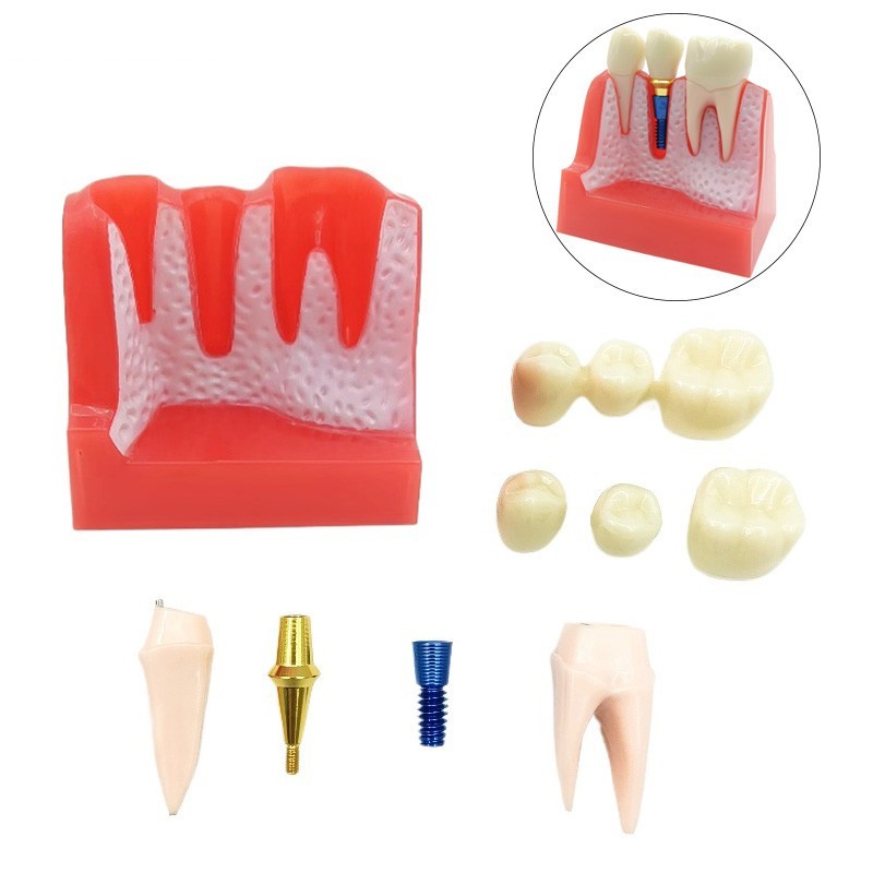 4 Times Dental Implant Analysis Crown Bridge Demonstration Study Teeth Model