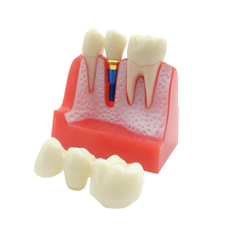 4 Times Dental Implant Analysis Crown Bridge Demonstration Study Teeth Model
