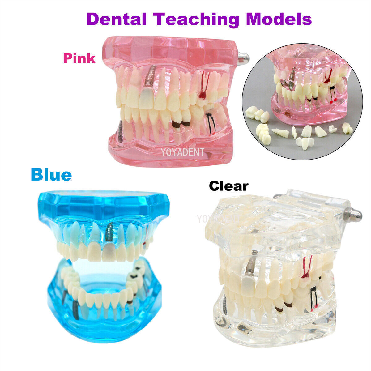 US Dental teeth Model Preparation Training Teaching Ortho Implant Typodont Demo
