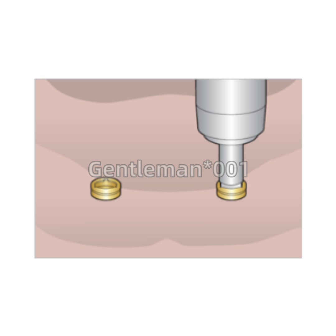 2Kits Dental Abutment Retentive Caps Inserts Locator Implan Metal Housing Cap