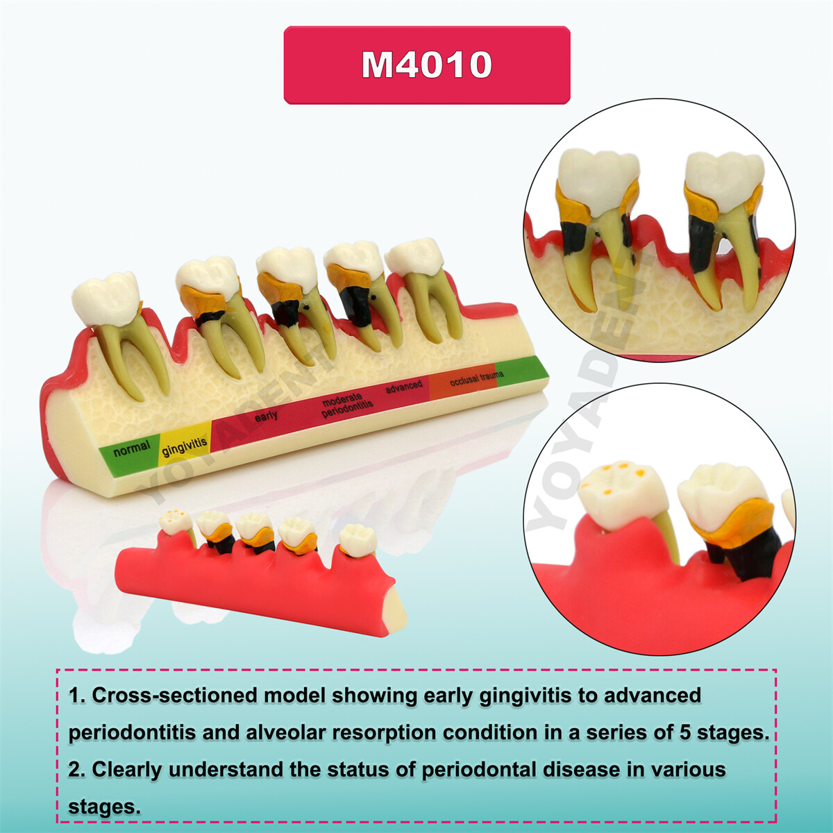 Dental Pathological Typodont Teeth Model Periodontics/Implant/Endodontic Caries