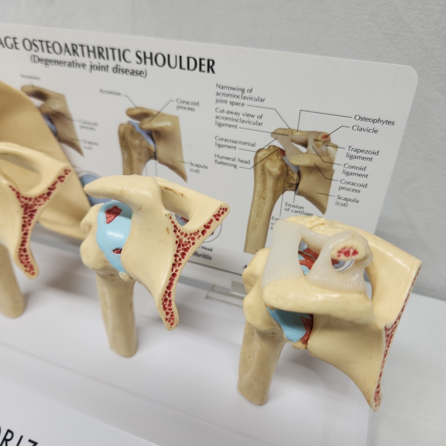 Degenerative Joint Disease 4 Stage Osteoarthritis Osteoarthritic Shoulder Model