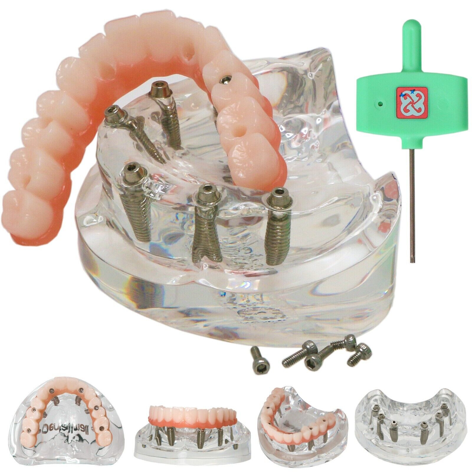 US Dental All-on-4/6 Screws Overdenture Implant Model Upper Jaw Restoration