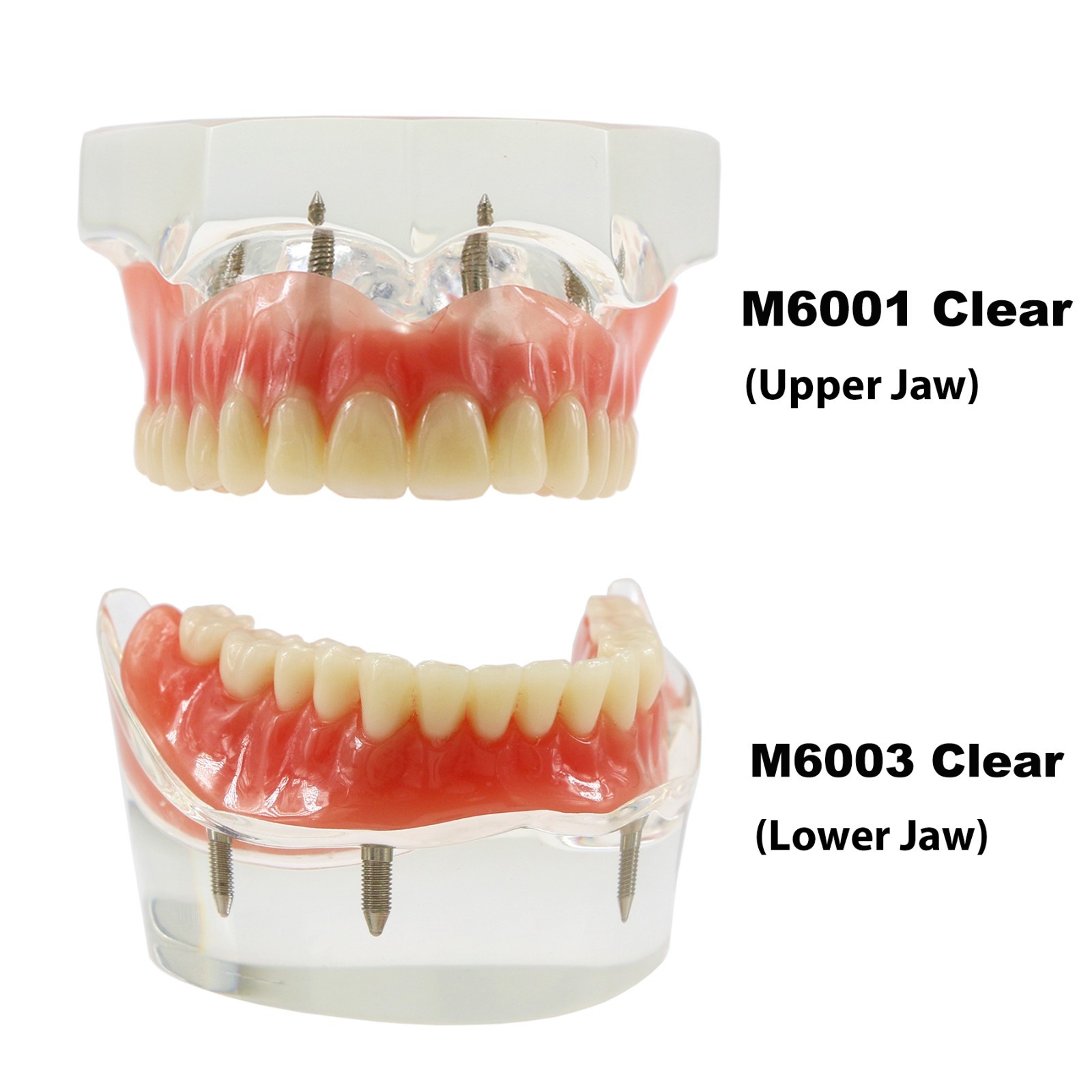 Dental Implant Overdenture Model Upper Lower Jaw Teeth Model with 2/4/6 Screws