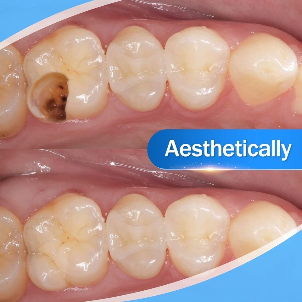 Dental Cement Teeth Resin Tooth Repair Dental Cement Cavity Filling Strong Repai