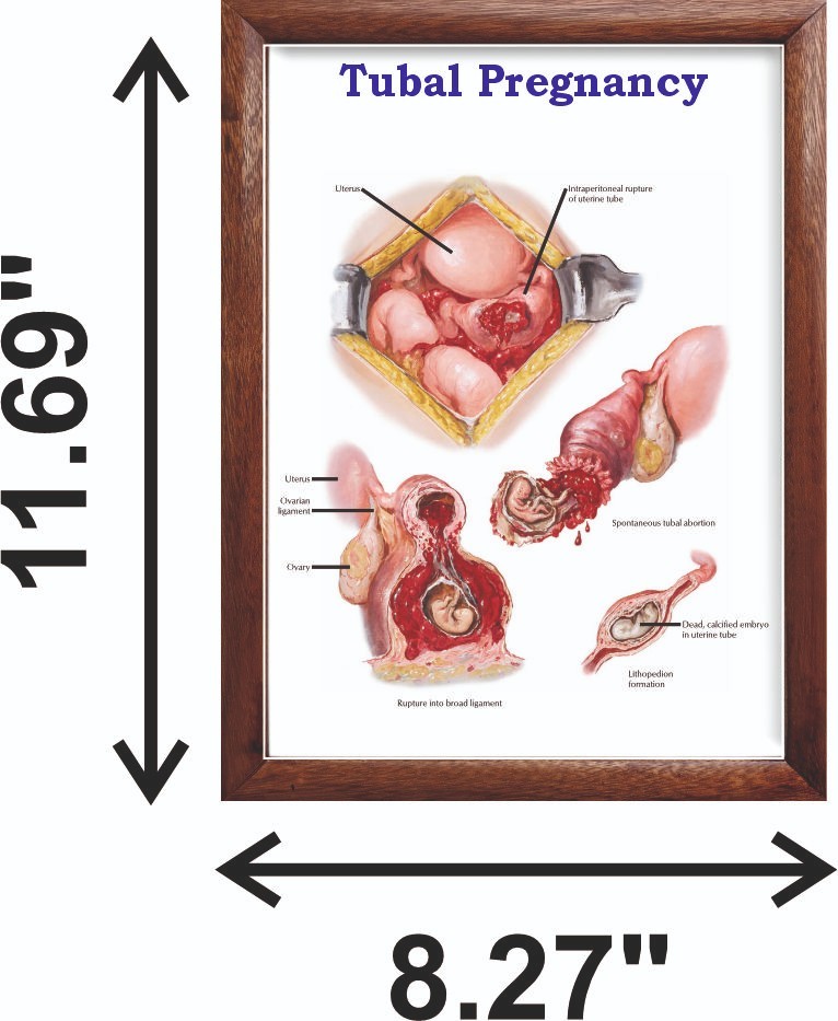 Tubal Pregnancy Chart 12×18 inches