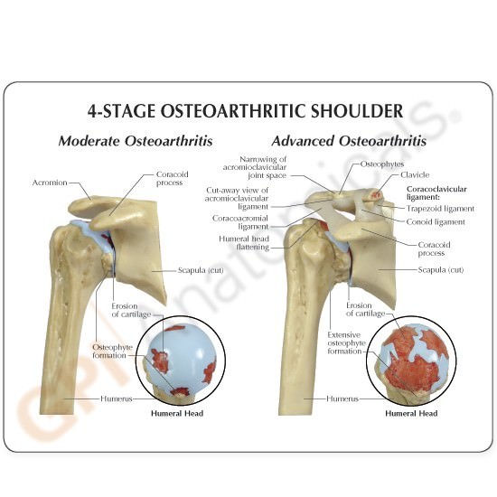 Shoulder Osteoarthritic 4-Stage GPI Anat Model Set LFA#1800 Make OfferSEE VIDEO
