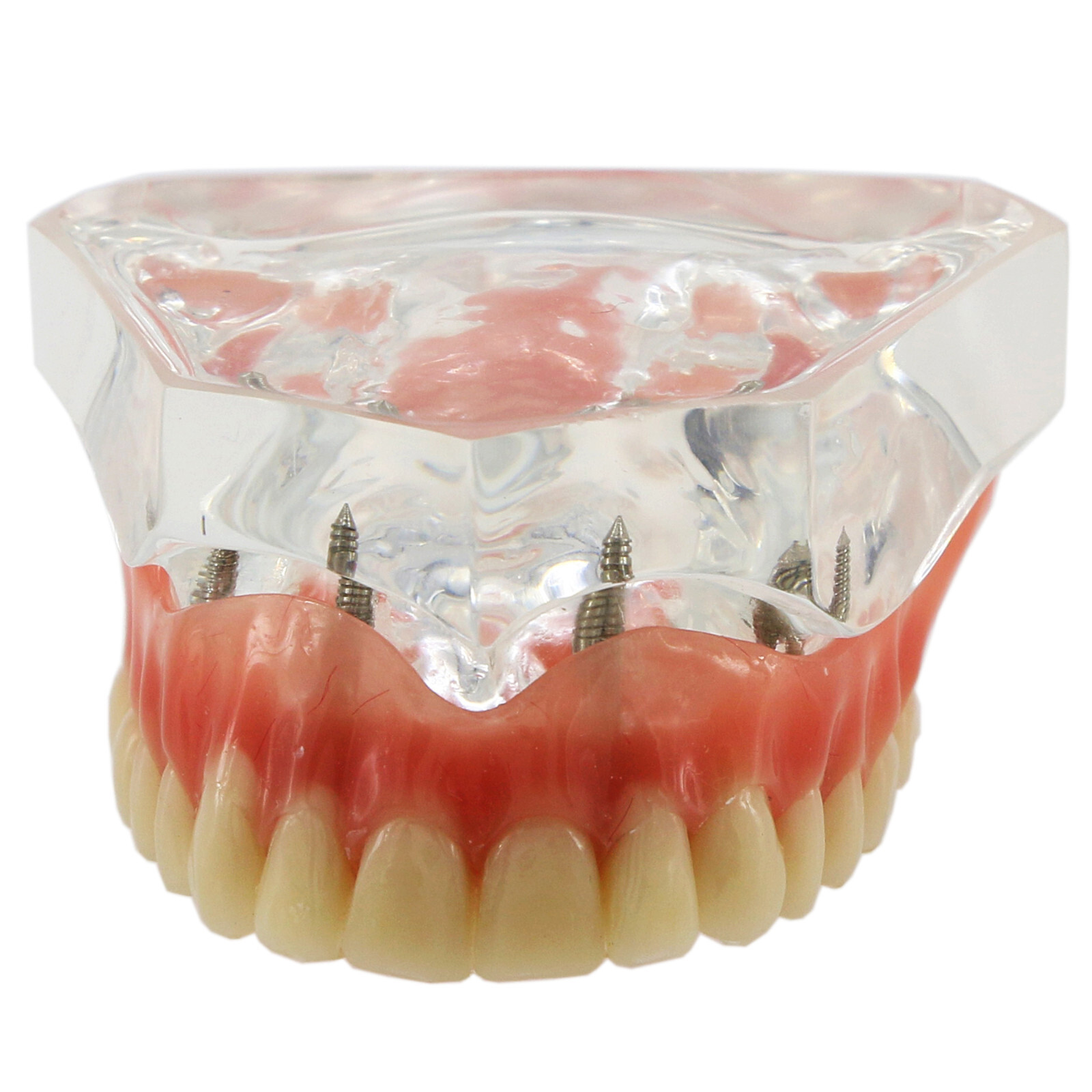 Implant Typodont Teeth Restoration Model Overdenture Practice Demo Series Dental