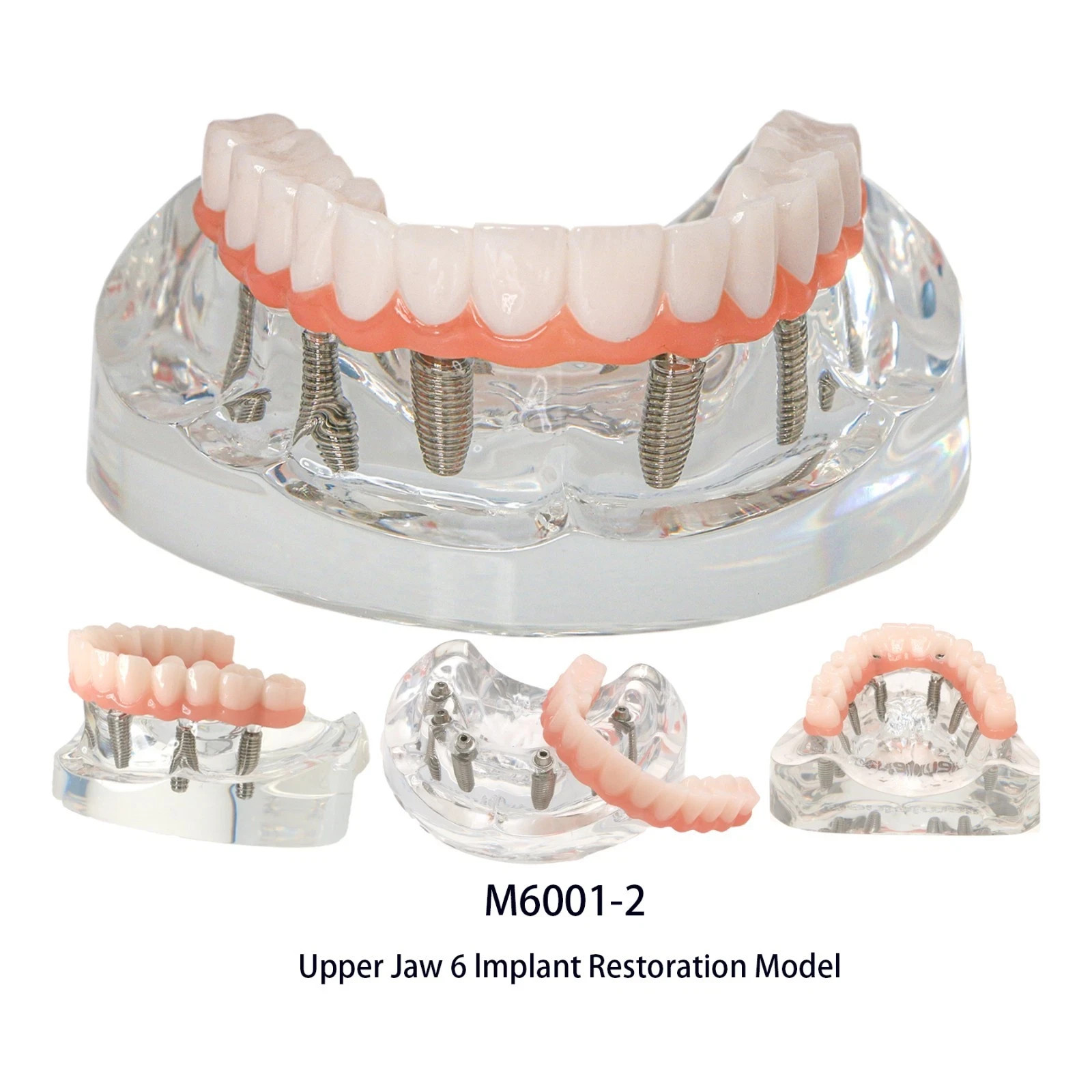 US Dental Overdenture All-on-4/6 Upper/Lower Jaw Teeth Model with 4/6 Screws