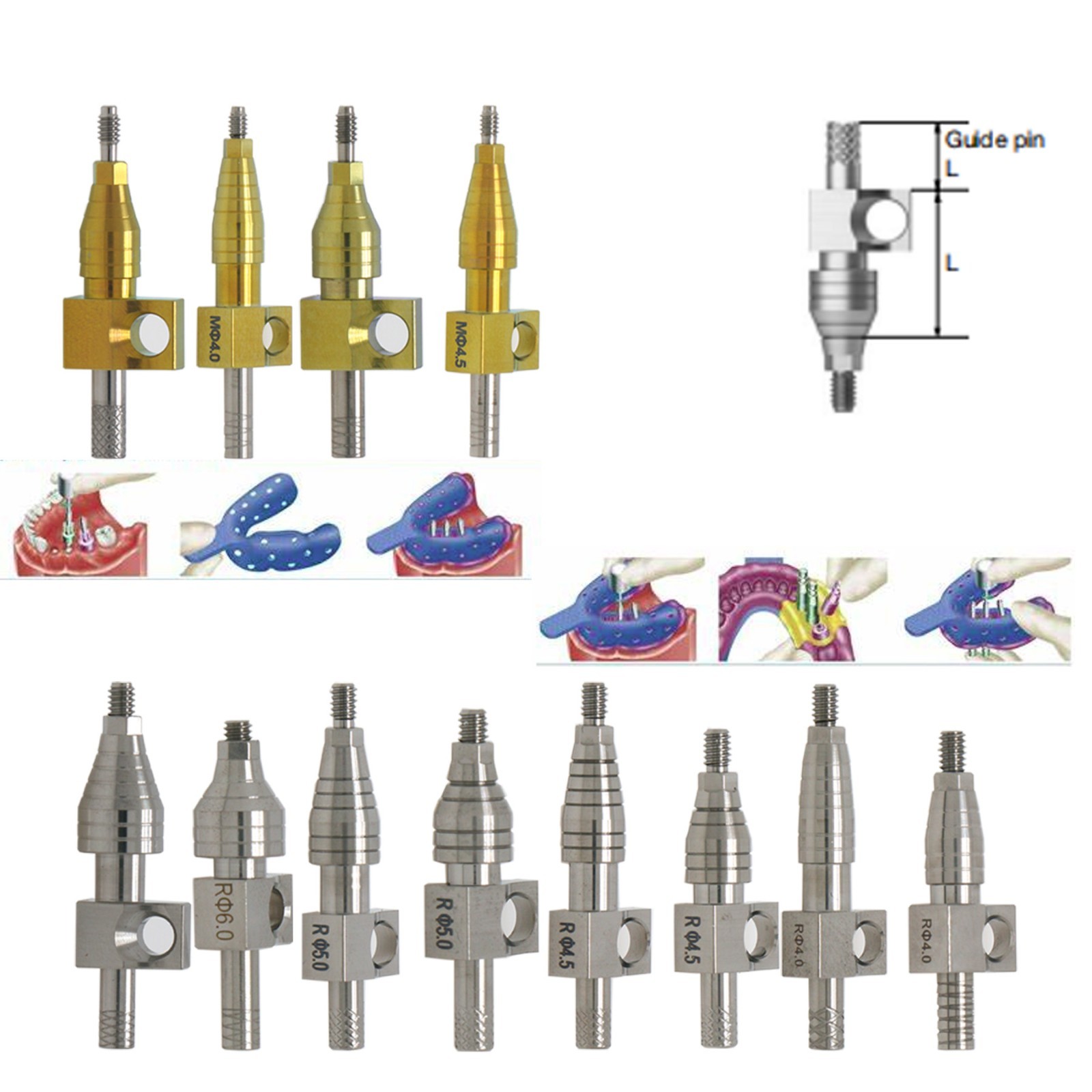 Hiossen ET Open/Close Tray Transfer Impression Coping Fits Mini/Regular implants