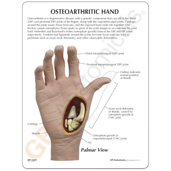 Hand Osteoarthritis (OA) GPI Anatomical Model LFA # 1930.Make Us An Offer! VIDEO