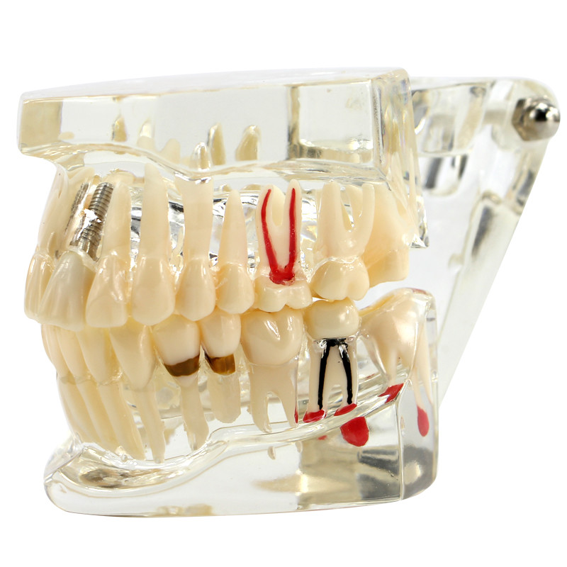 Dental Implant and Restoration Model Transparent Pathological Teeth Study Model