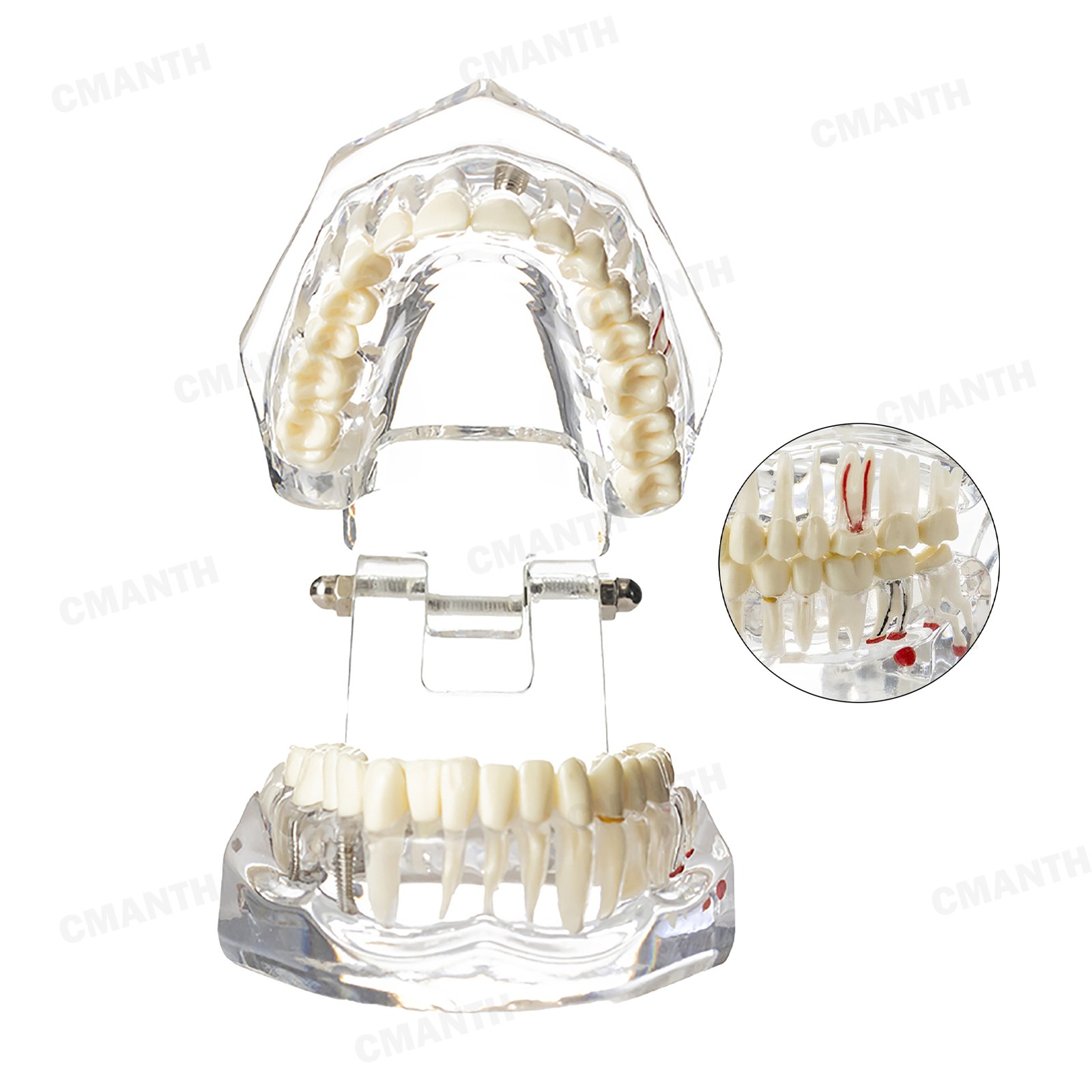 US Dental Teeth Implant Restoration Model Transparent Pathological Study Demo