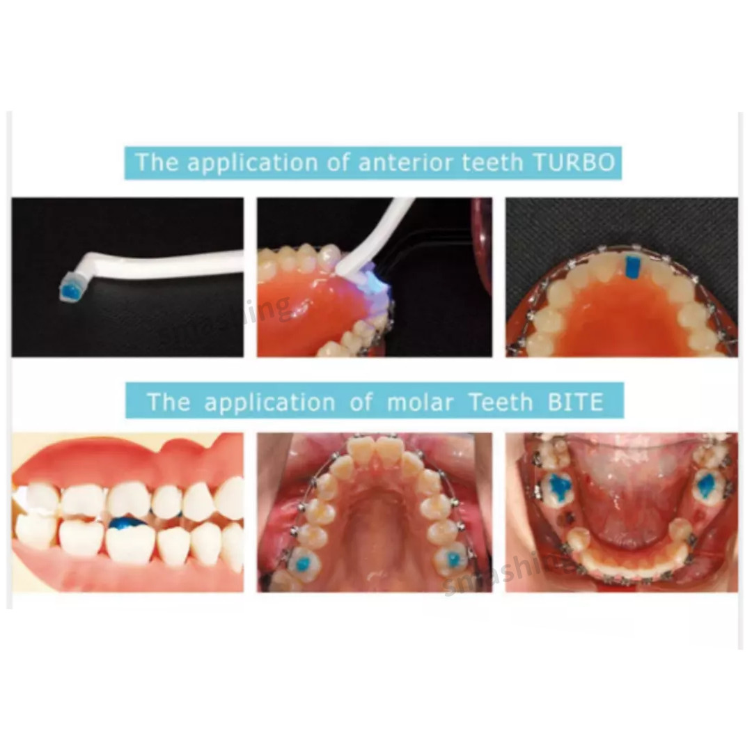 1Pcs Dental TURBO Blue Glue Composite Resin Orthodontic Adhesive Light Cure Band