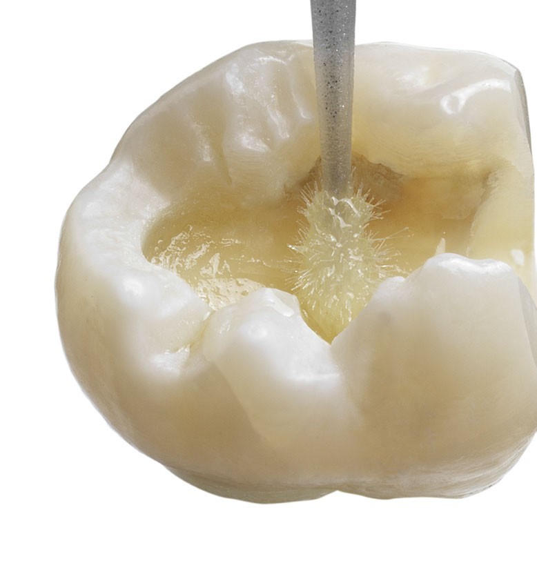 Dentsply Prime And bond NT Free Shipping
