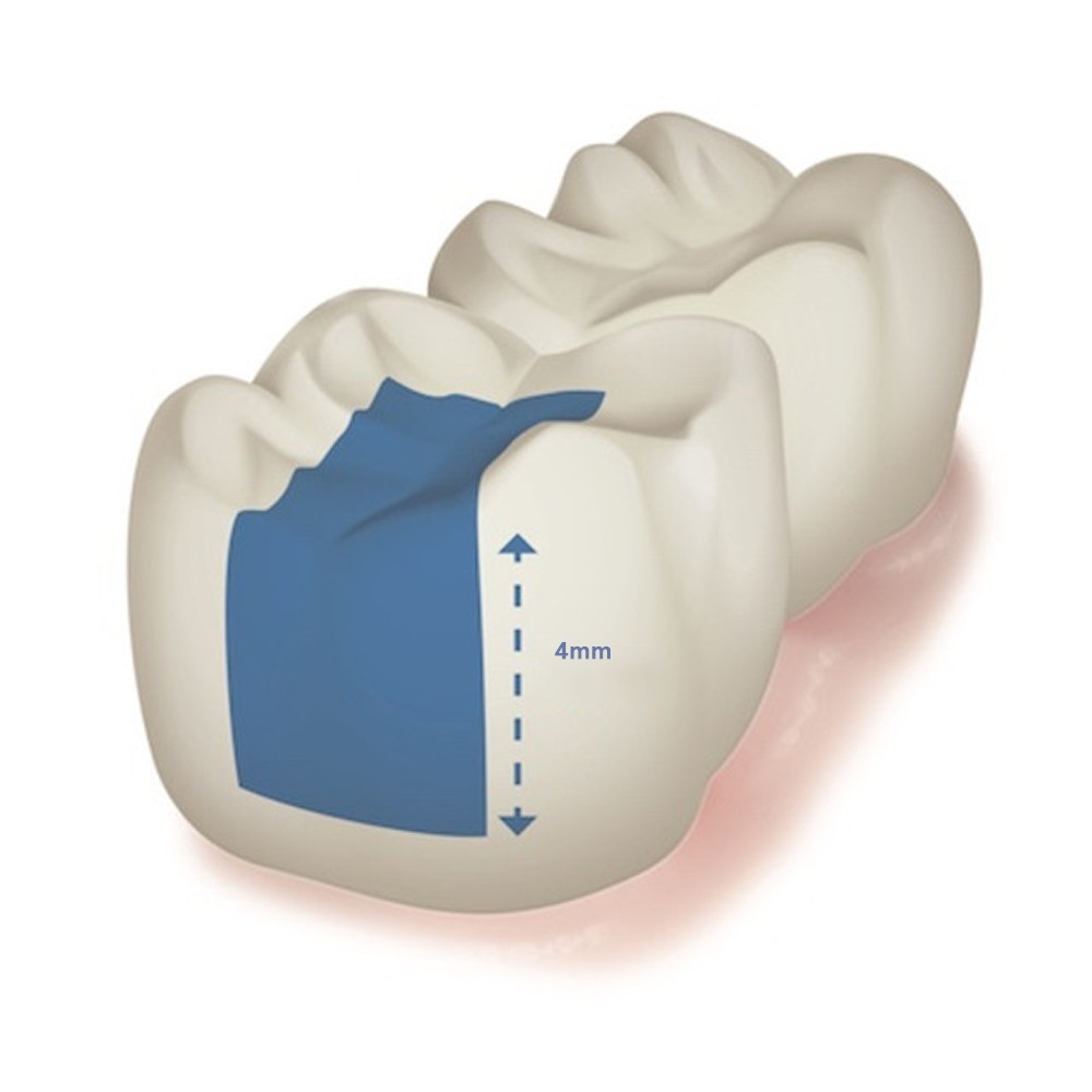 Prime Dental Bulkfil (Packable) Free Shipping