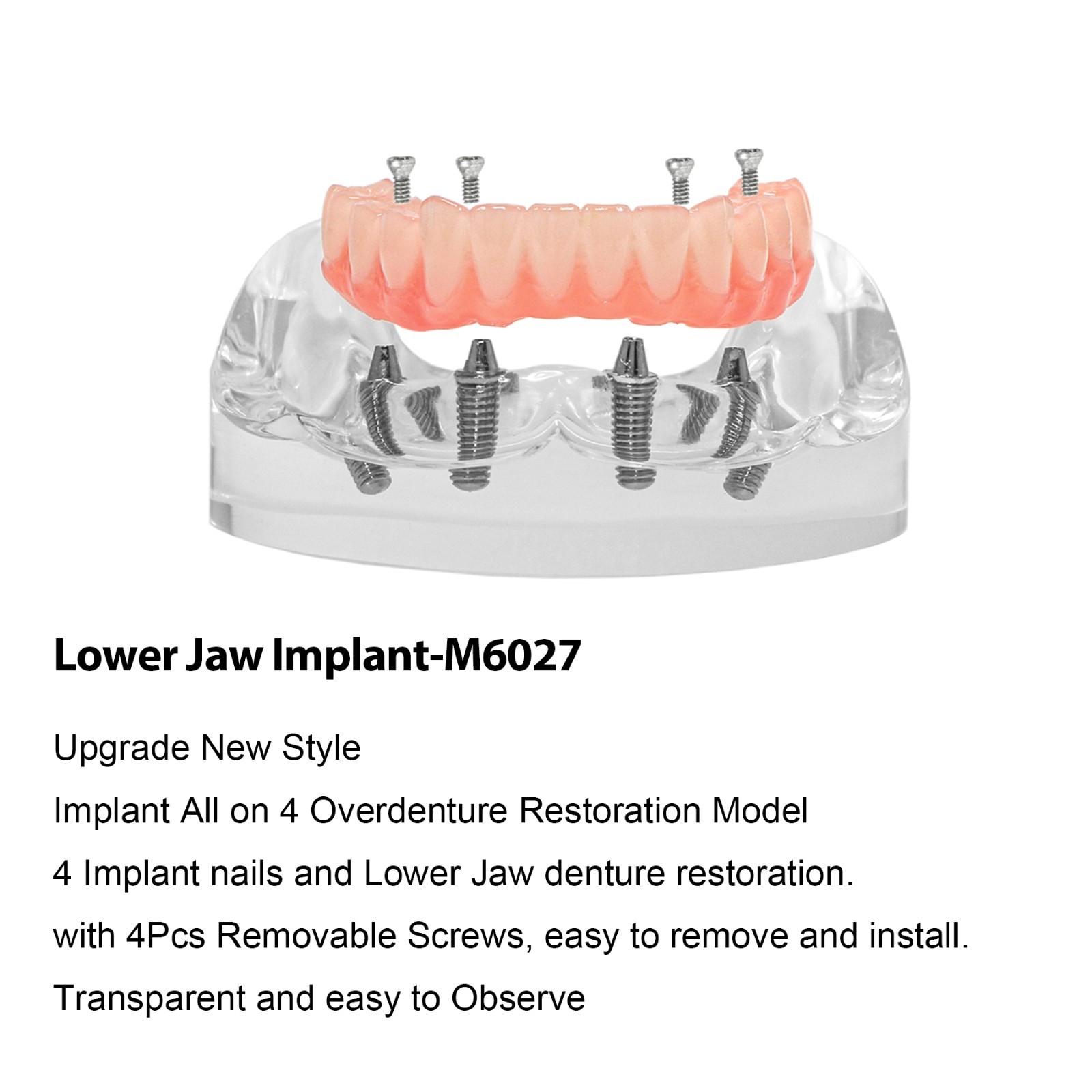 Dental Implant Overdenture Model Upper Lower Jaw Teeth Model with 2/4/6 Screws