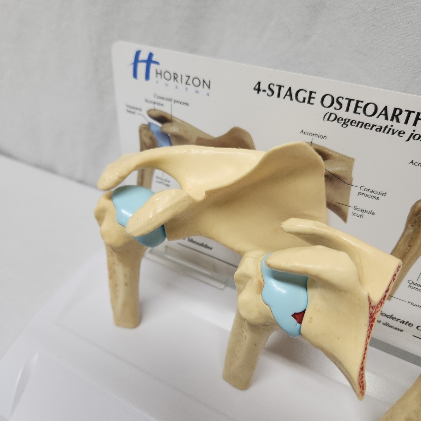 Degenerative Joint Disease 4 Stage Osteoarthritis Osteoarthritic Shoulder Model
