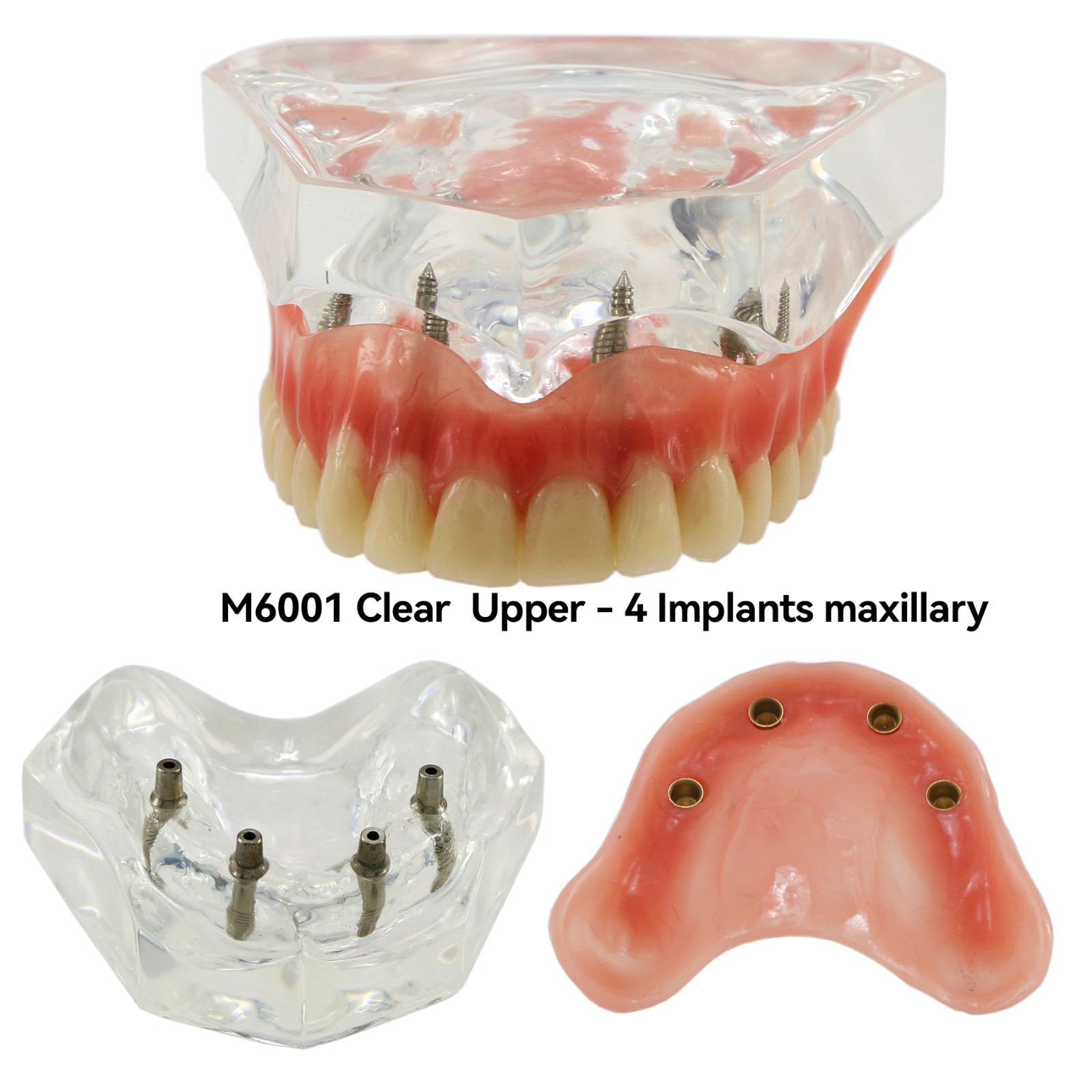 Dental Teeth Model 2 4 Implant Overdenture Typodont Restoration Demo Upper Lower