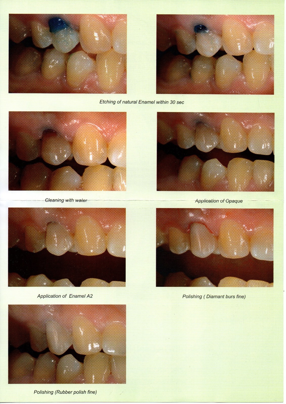 Dental Camouflage Flow Nano composite for direct laminate veneers Germany