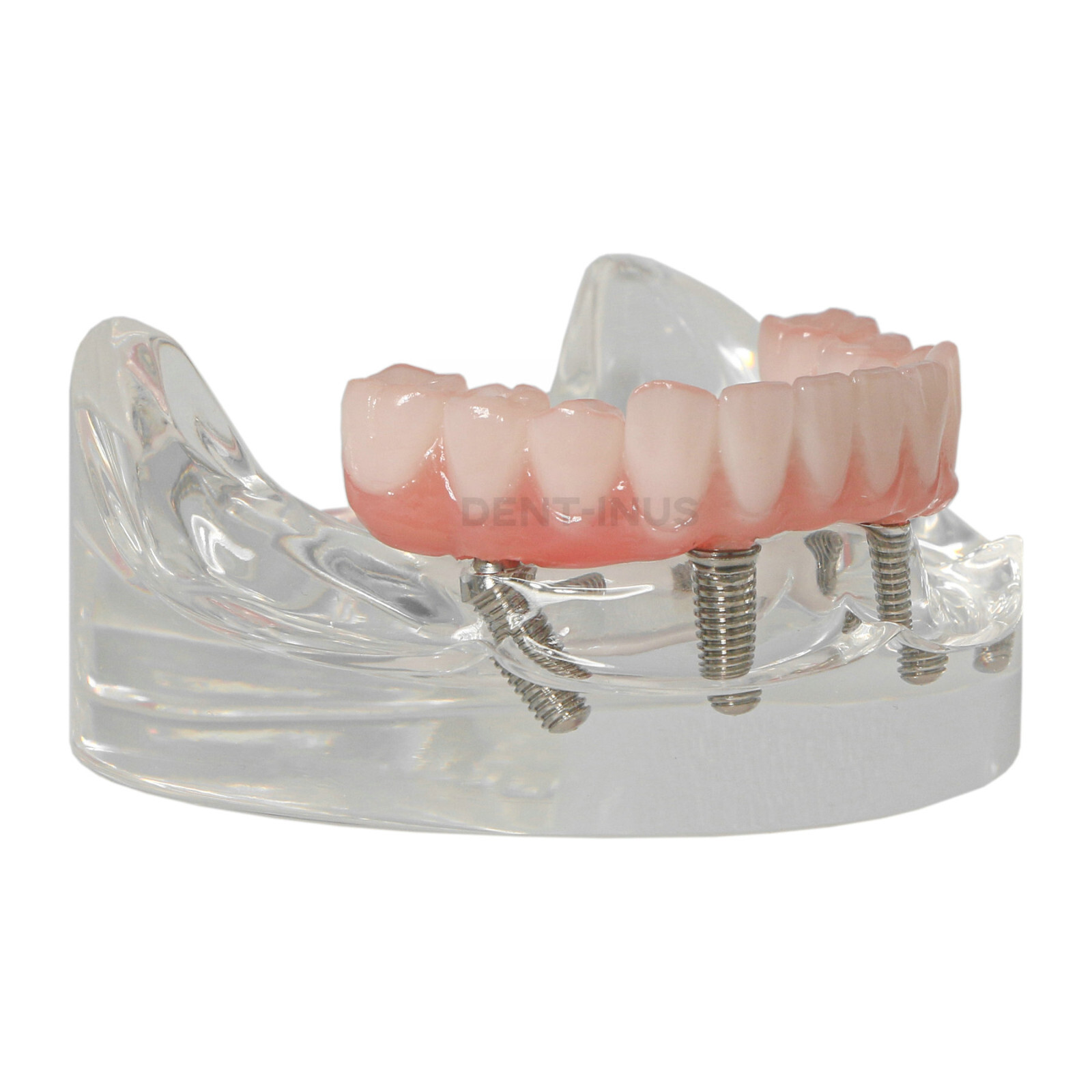 Dental 4 Implants Demo Implant Teeth Model Restoration Overdenture Upper/Lower