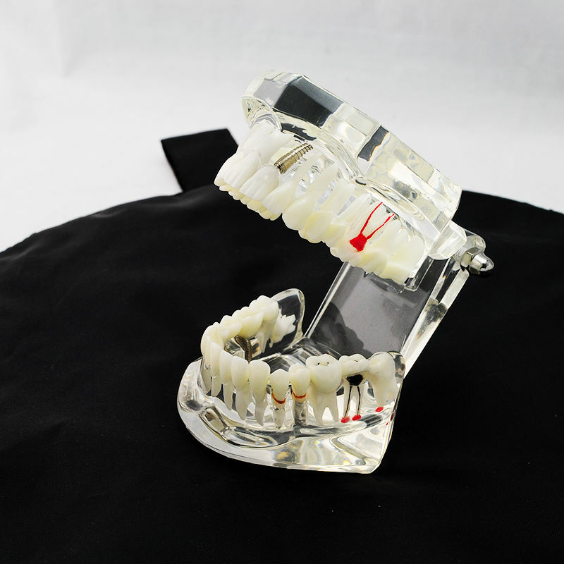 Dental Implant and Restoration Model Transparent Pathological Teeth Study Model