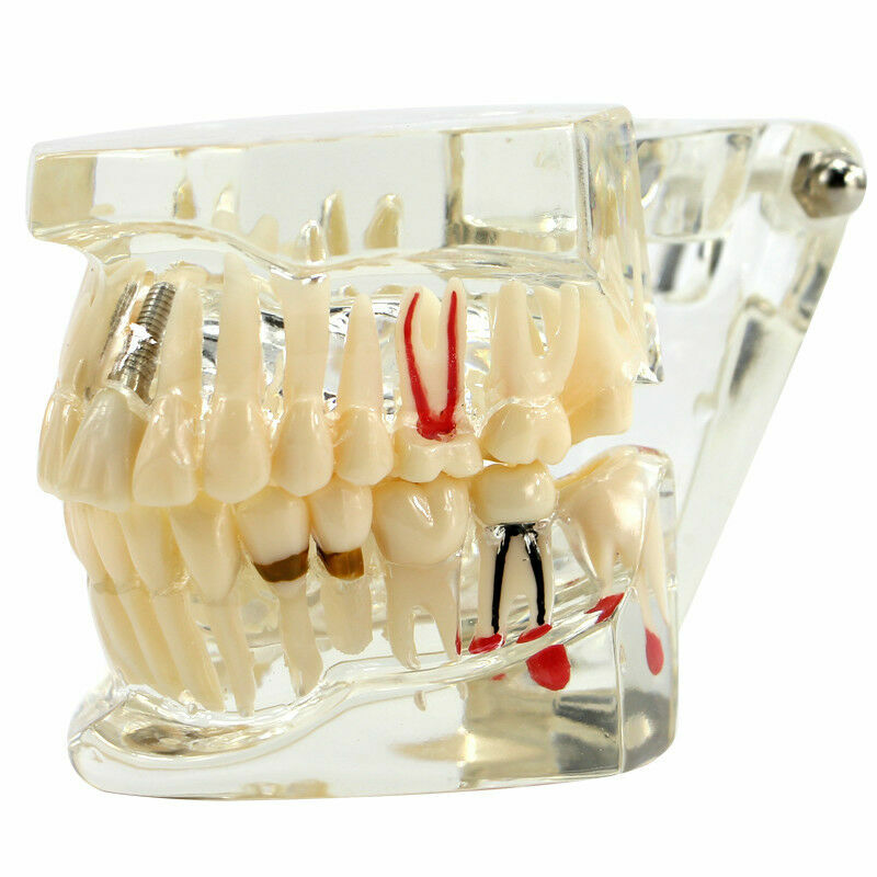 Dental Fake Teeth Study Model Implant Disease Education Denture Teach Analy
