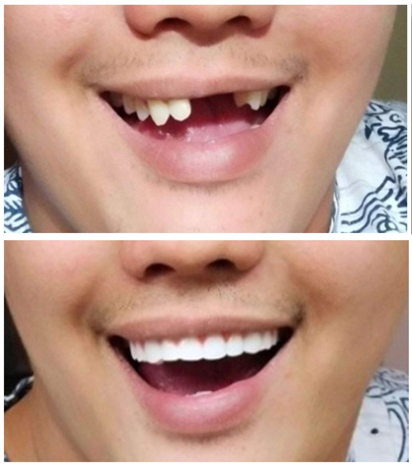 Instant Smile Flexible Lower Veneer Removable Cosmetic 1 Count (Pack of 1)