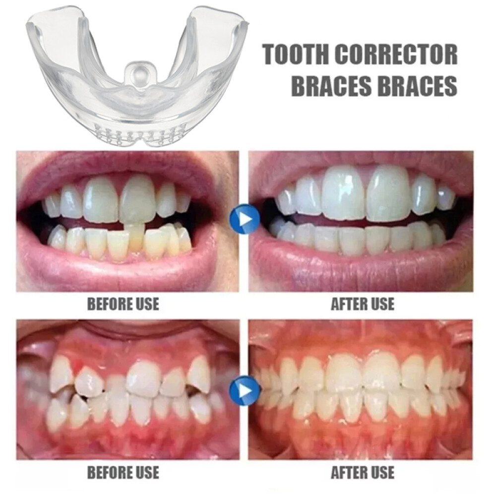 3-Stage Adult Teeth Aligners Orthodontic Braces Trainer for Dental Alignment Hot