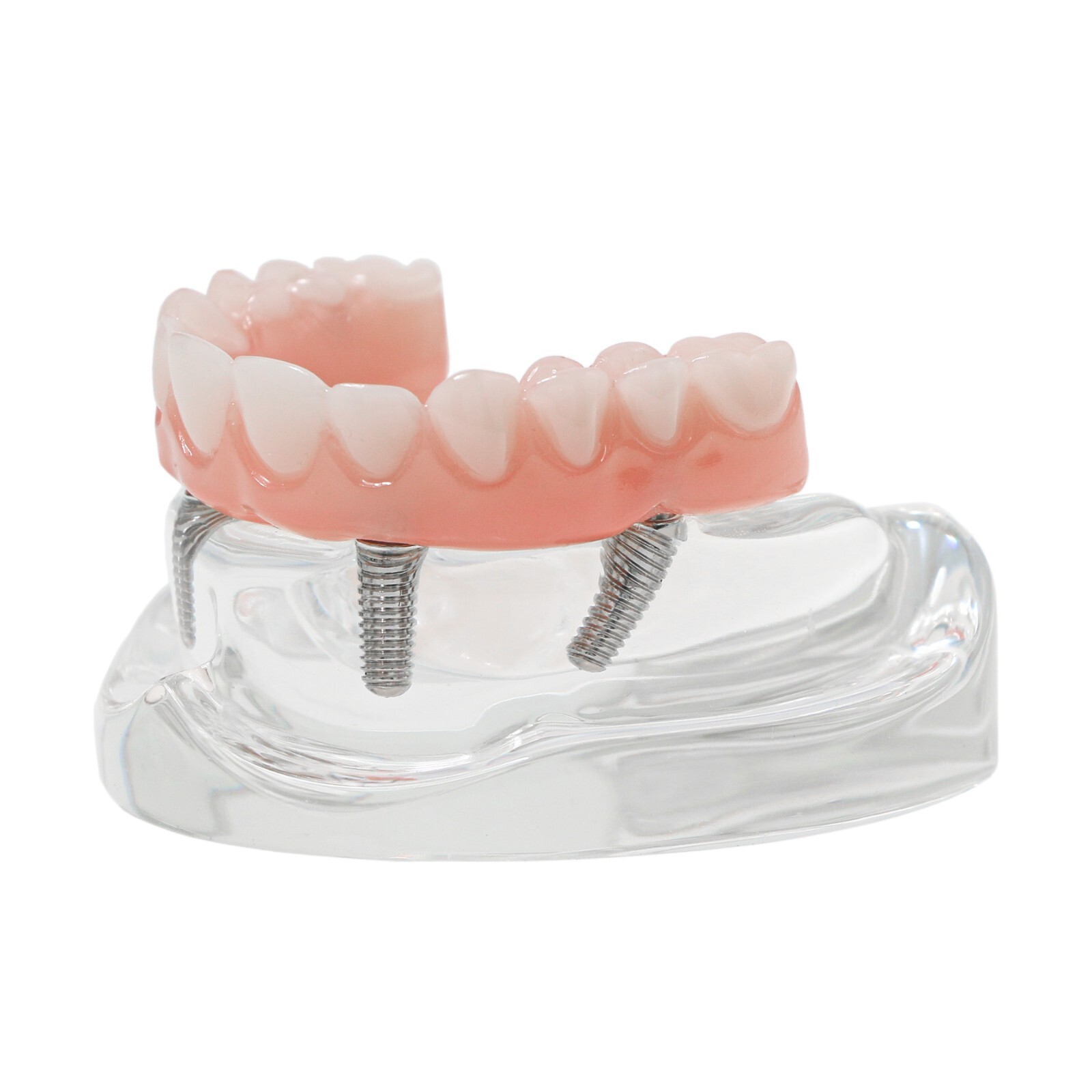 Dental Implant Overdenture Model Upper Lower Jaw Teeth Model with 2/4/6 Screws