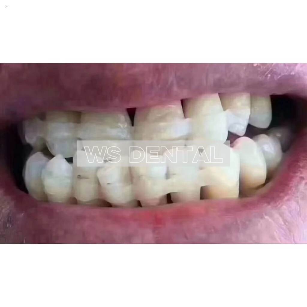 Dental Glass Fiber Splint Composite Resin Bonding Ribbon Flexible Fiber Strips