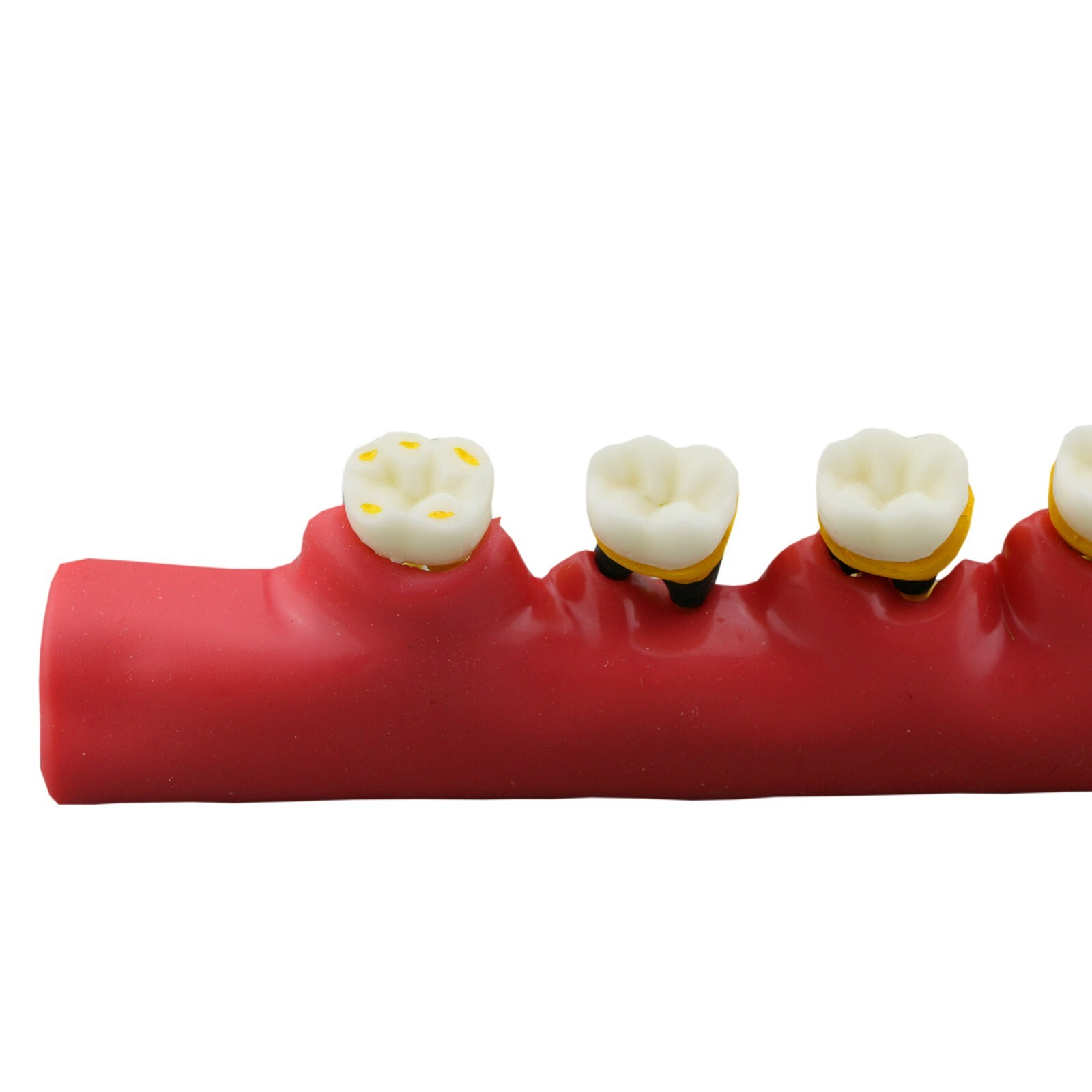 Dental Periodontics Disease 5-Stage Teeth Model Perio Disease Assort Demo Model