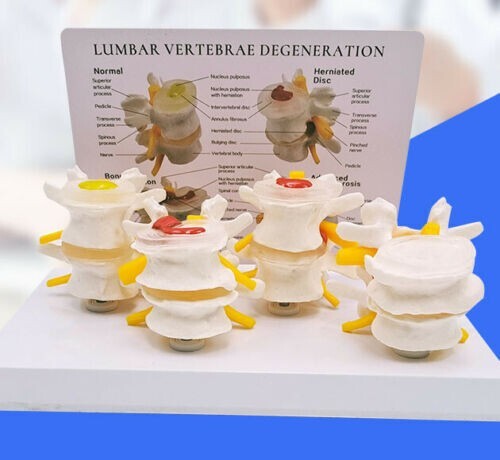 Sick Human Lumbar Vertebrae Degenerative Disc Disease Model Anatomical
