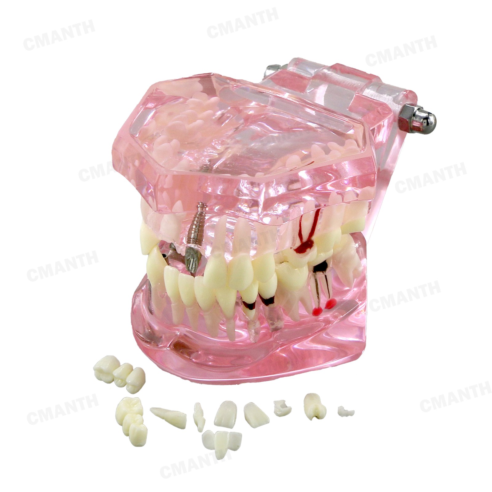 US Dental Teeth Implant Restoration Model Transparent Pathological Study Demo