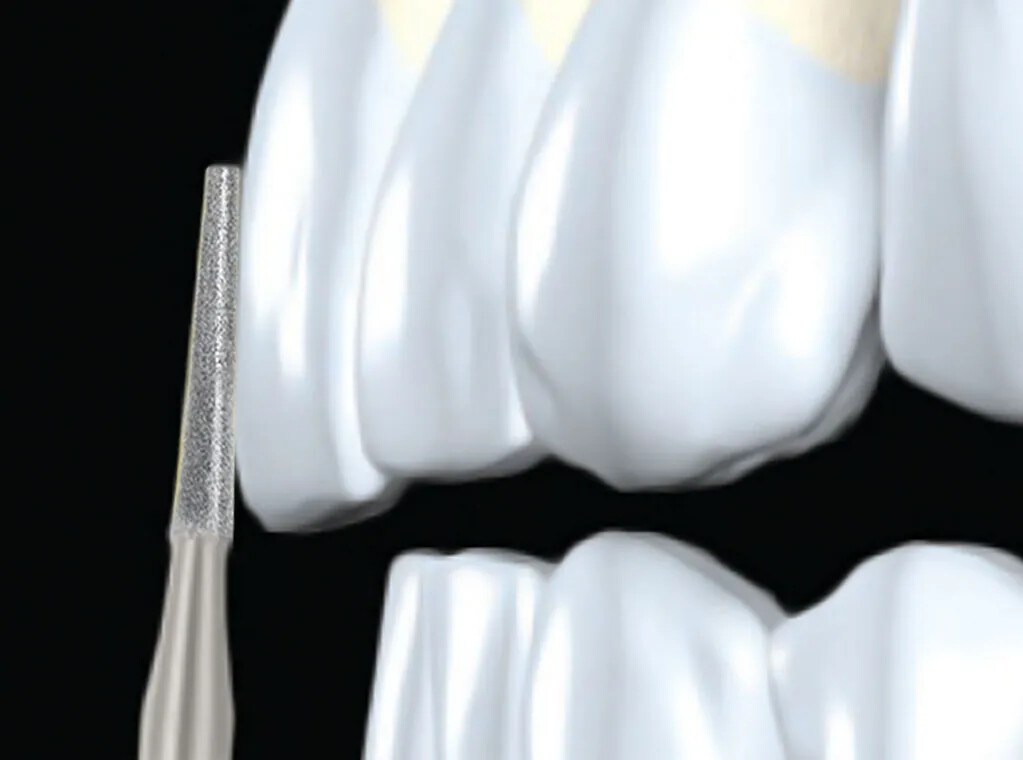 Frank Dental Taper Fissure Diamond Bur FG – TF (Made in India)Cavity Diamond bur