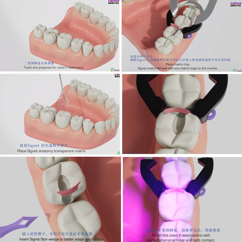 Clear Matrix Band Transparent Bow Matrices Dental Anterior Front Teeth Posterior