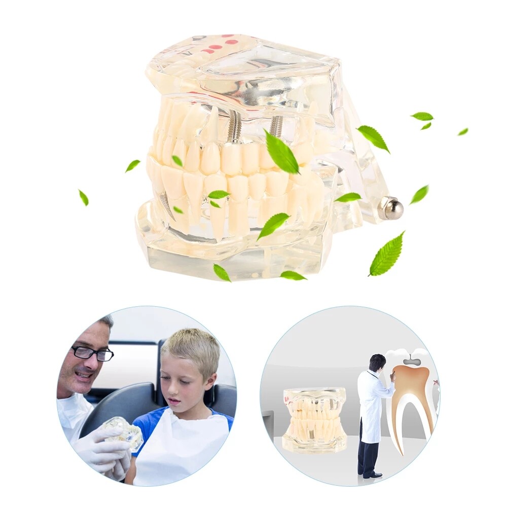 Dental Fake Teeth Study Model Implant Disease Education Denture Teach Analy