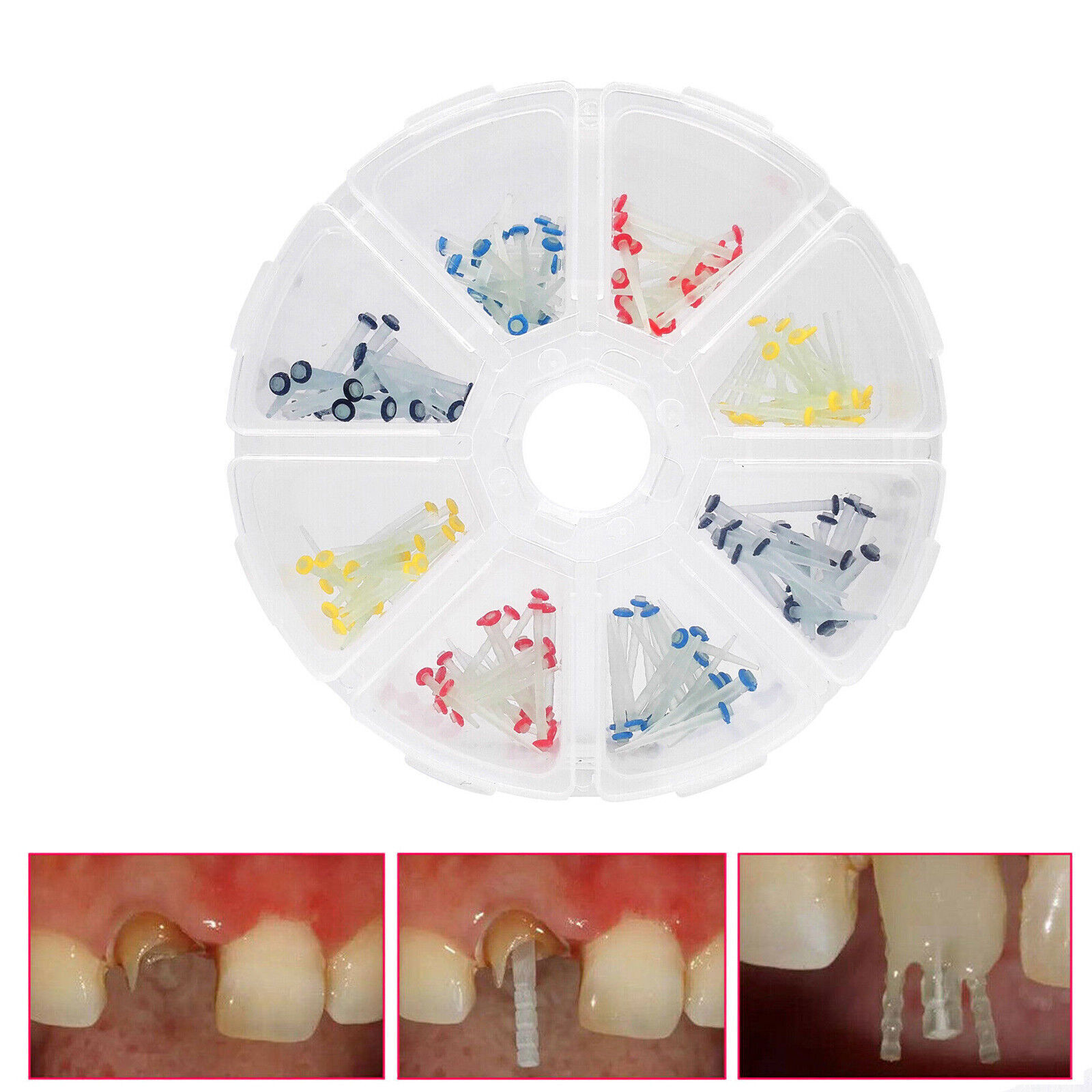 Dental Fiber Post Kit Mixed/Screw/Straight Post Quartz Glass Thread Pile