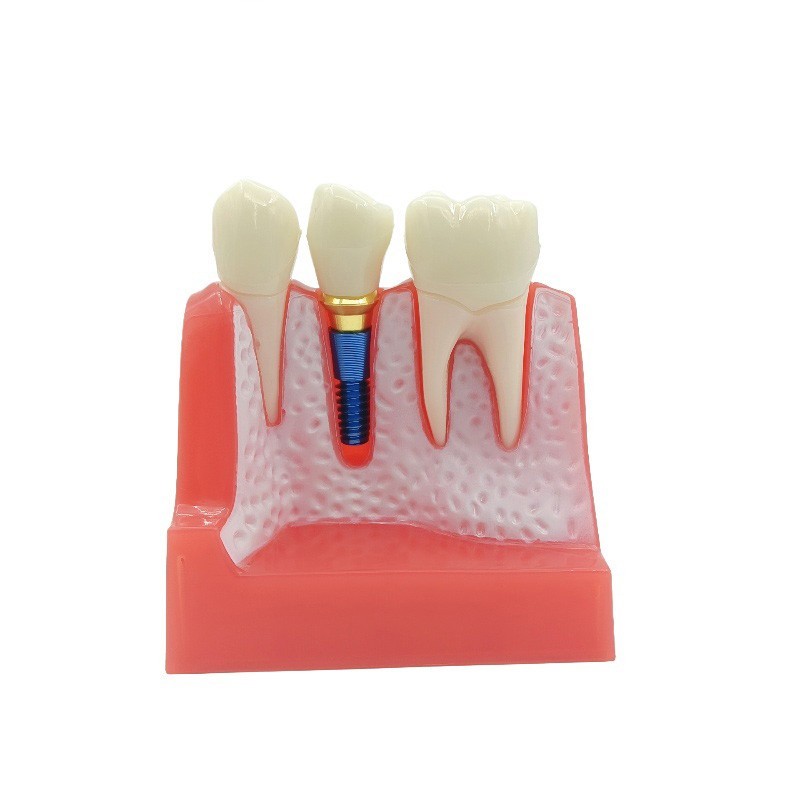 4 Times Dental Implant Analysis Crown Bridge Demonstration Study Teeth Model