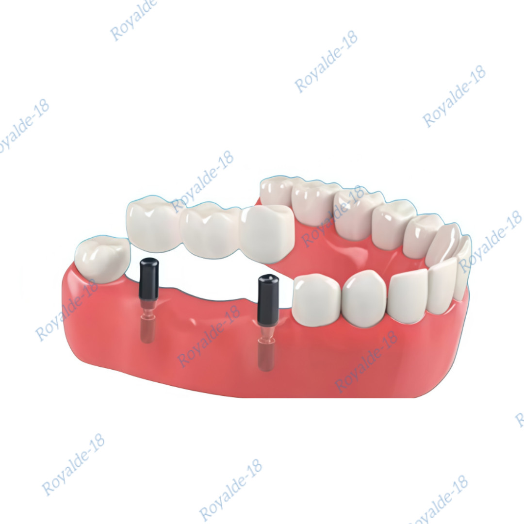 Novaloc Retention Inserts Caps Tool Dental Peek Matrix Locator Housing Mounting