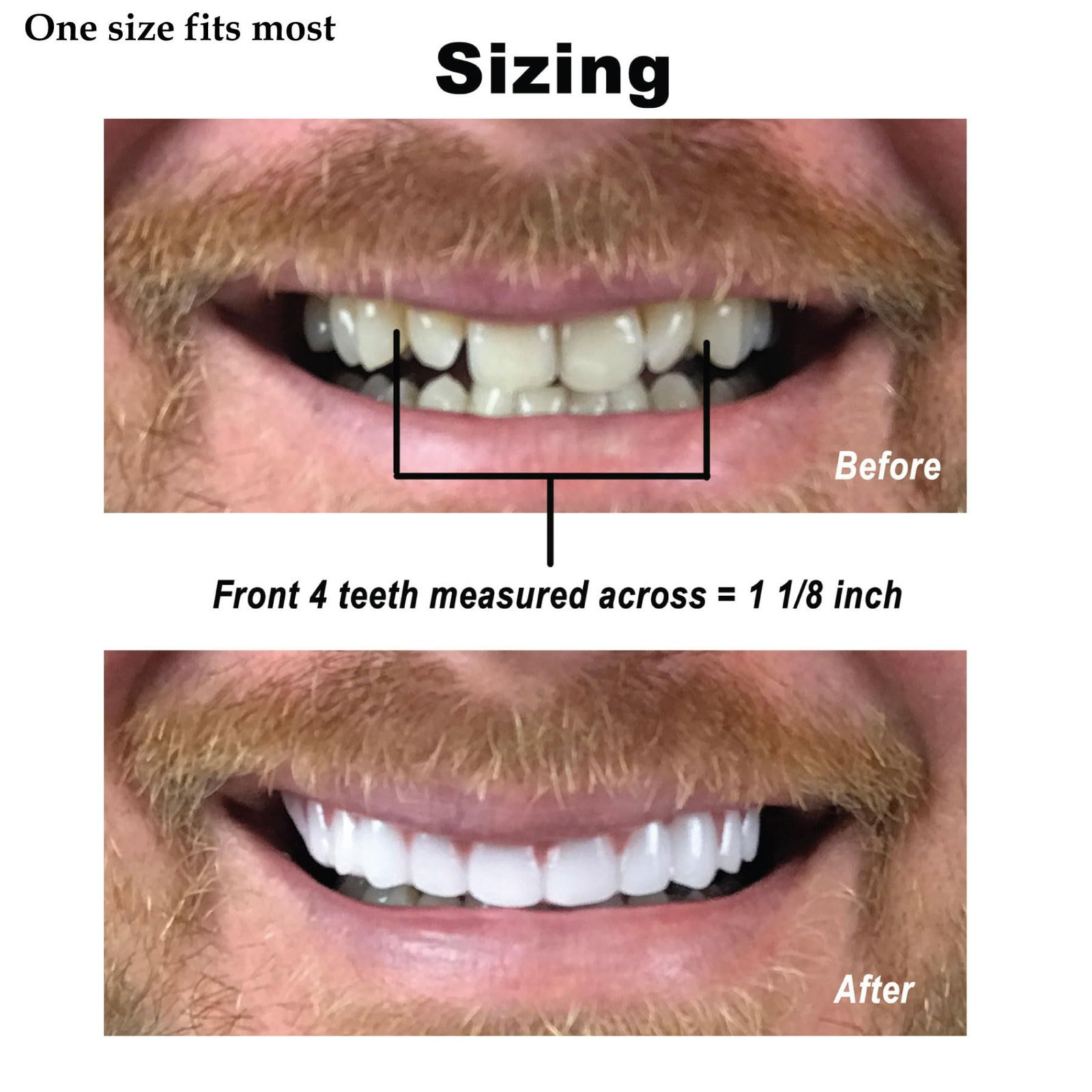 Instant Smile Comfort Fit Flex – Bright Shade – Upper 1 Count (Pack of 1)