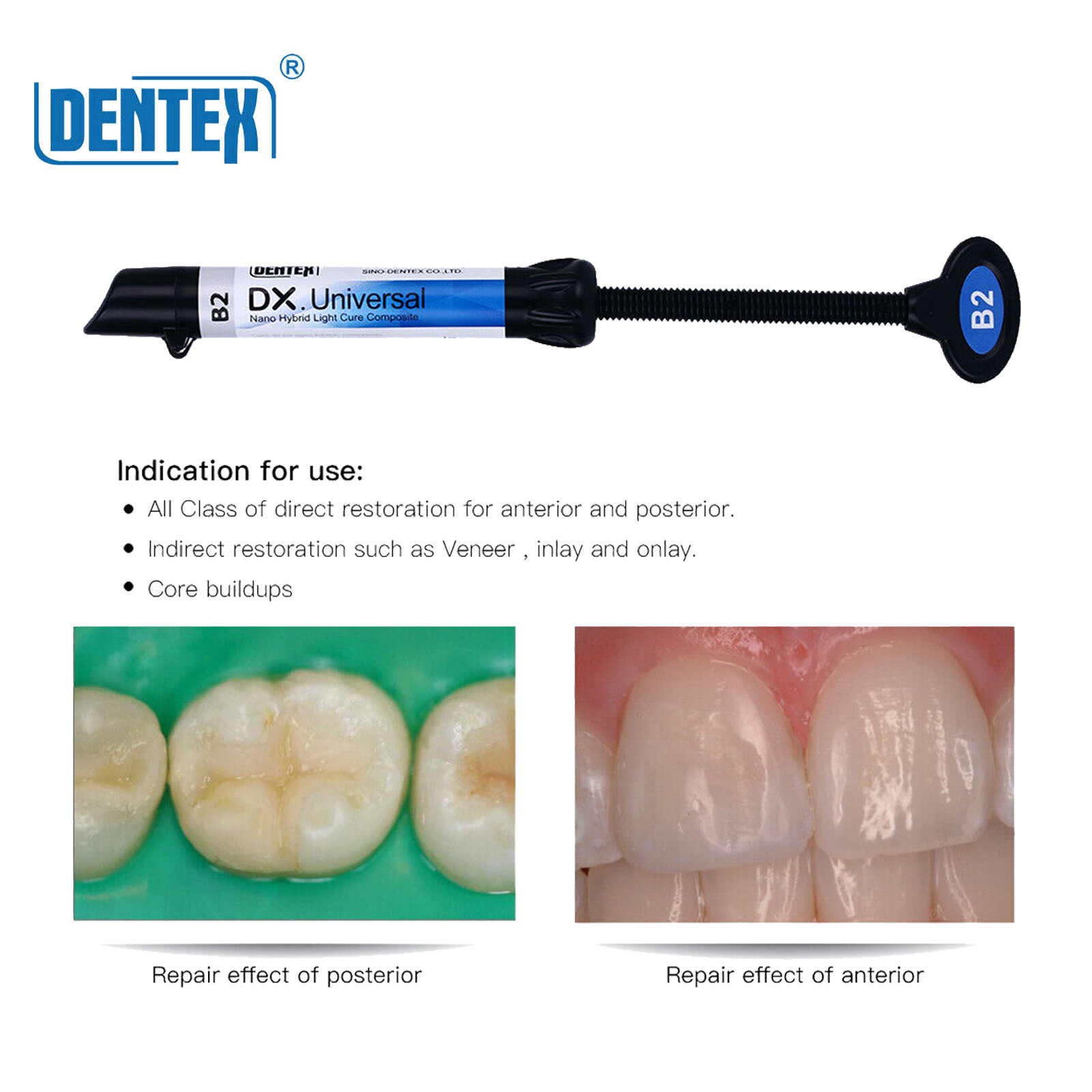 Dental Dentex Universal /Flowable Medium Flow Light Cure Composite Resin Refill