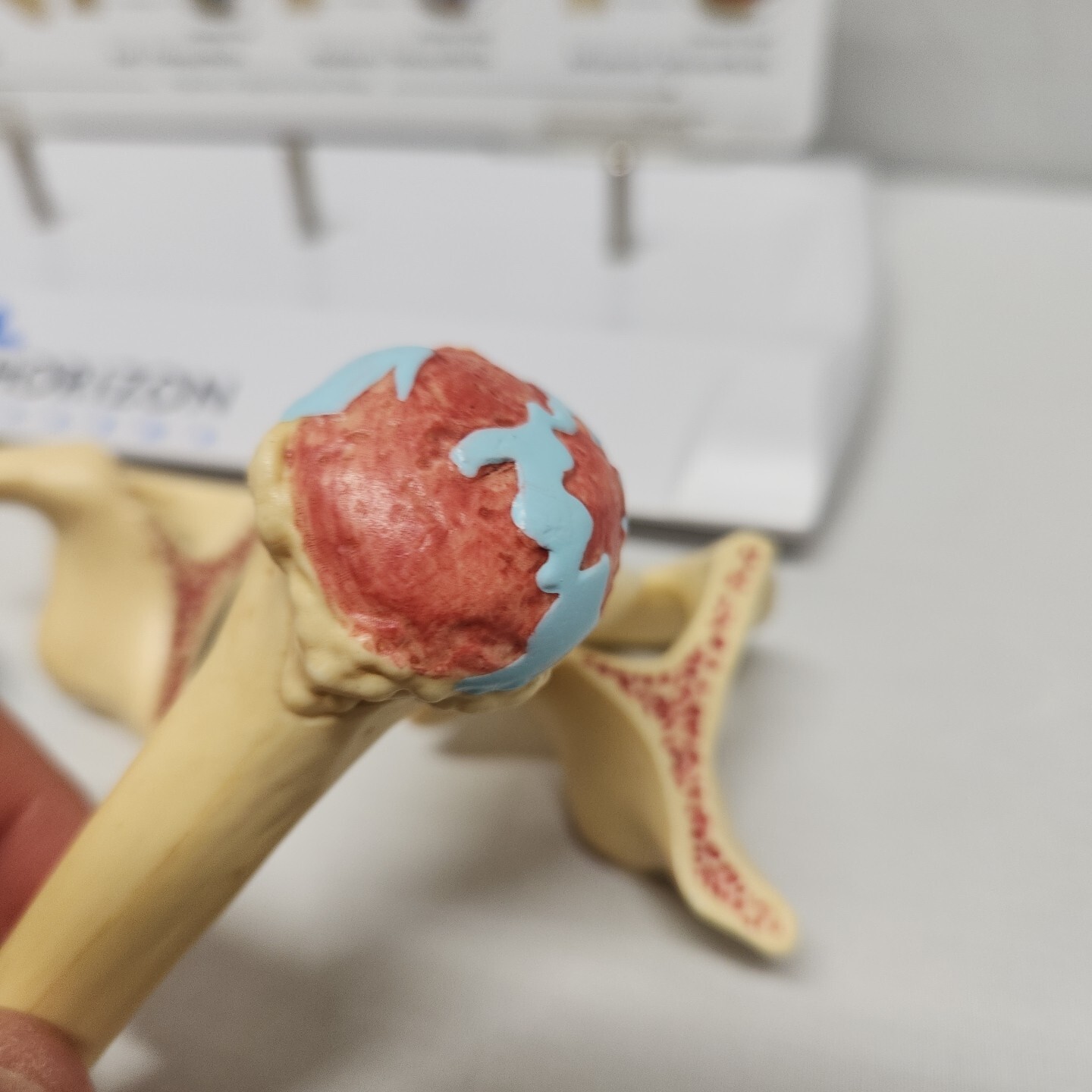 Degenerative Joint Disease 4 Stage Osteoarthritis Osteoarthritic Shoulder Model