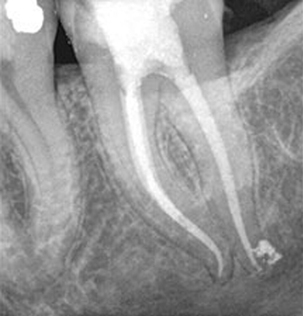WaveOne Gold Primary 21mm Endodontic Root Canal 3 Files. READ