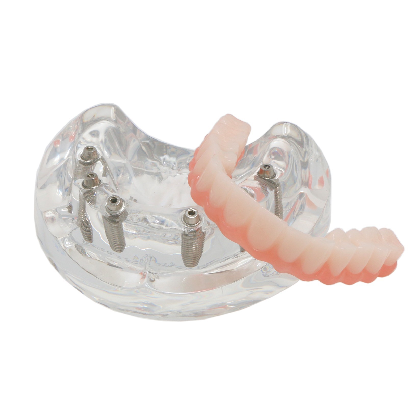 Dental Implant Overdenture Model Upper Lower Jaw Teeth Model with 2/4/6 Screws