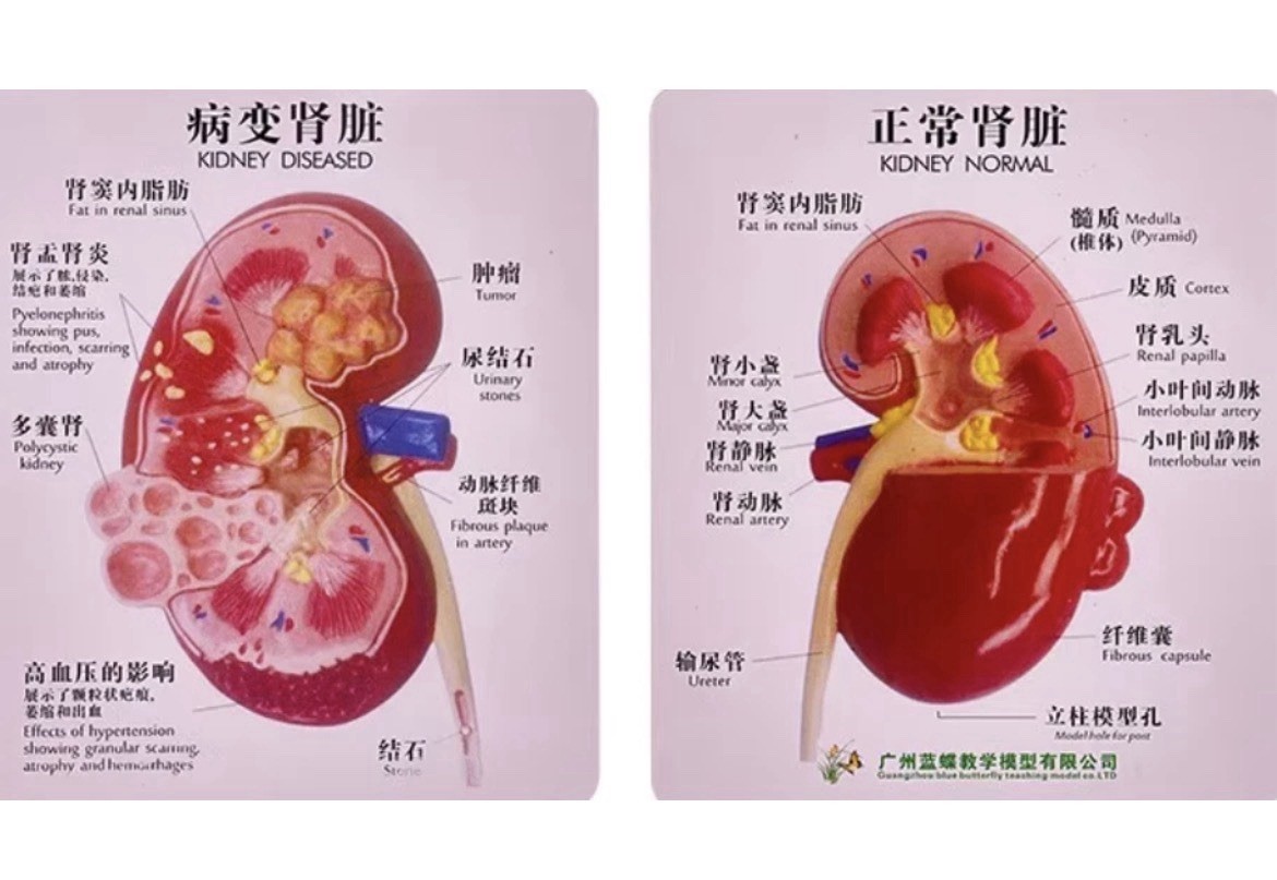 NEW Human Normal/Pathological Kidney Model Anatomy Medical Teaching Model
