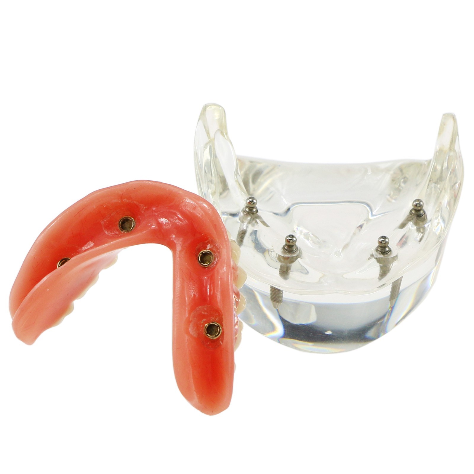 Dental Implant Overdenture Model Upper Lower Jaw Teeth Model with 2/4/6 Screws