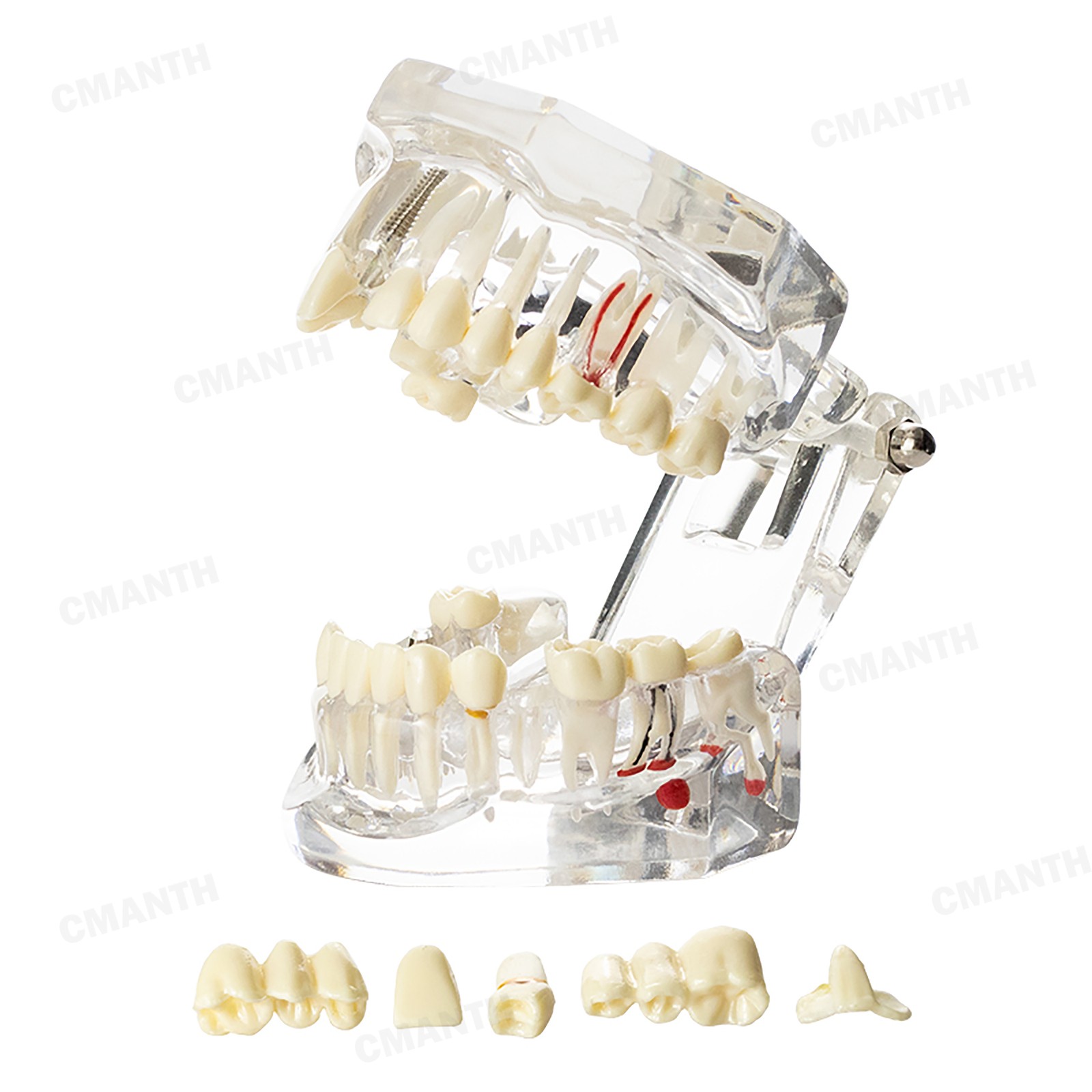 US Dental Teeth Implant Restoration Model Transparent Pathological Study Demo