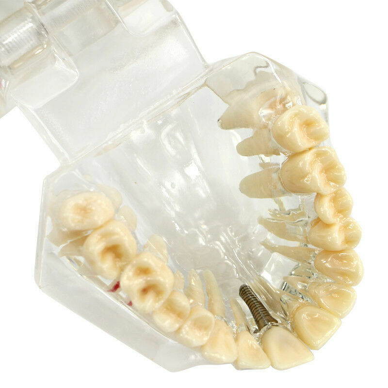 Dental Fake Teeth Study Model Implant Disease Education Denture Teach Analy