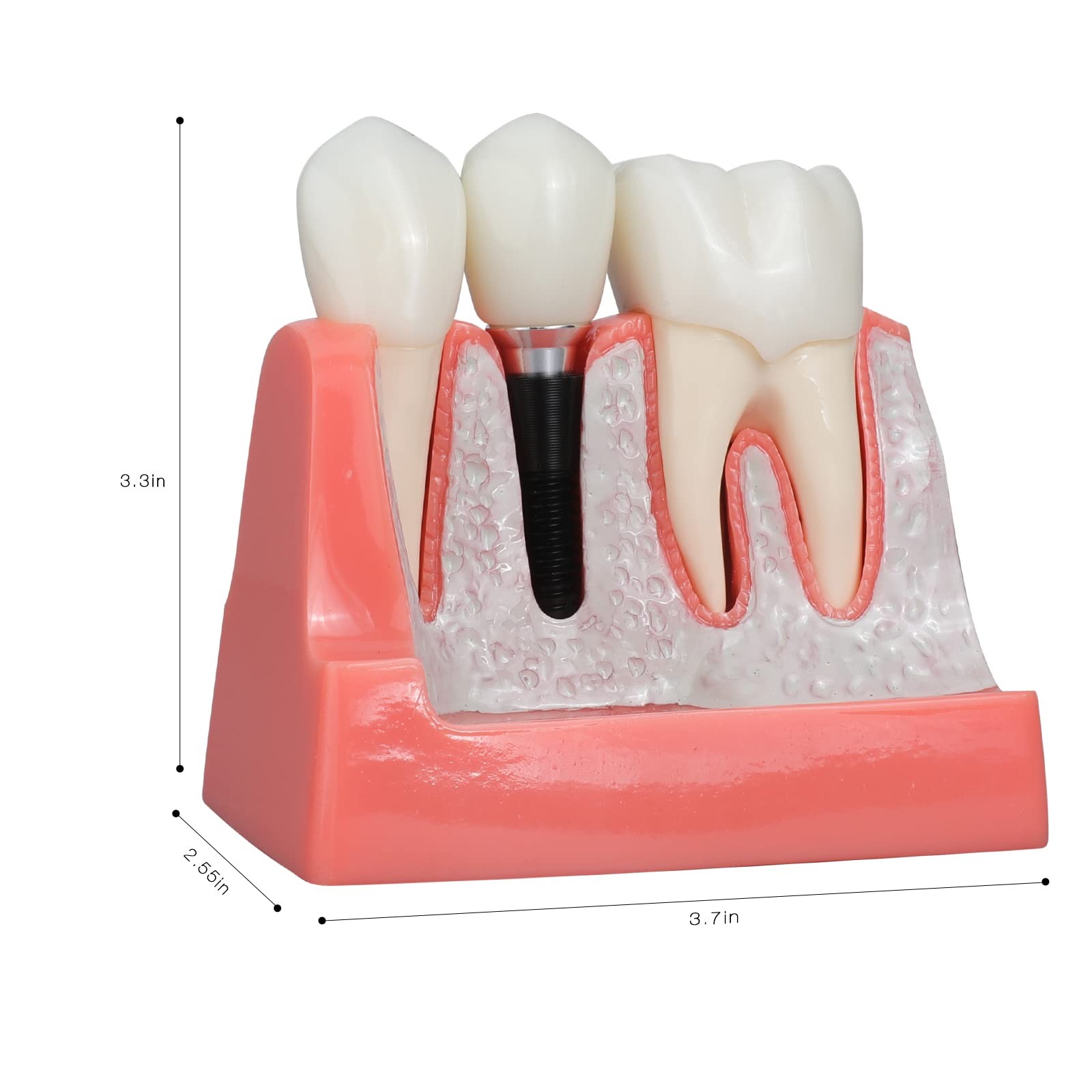 ANNWAN Dental Implant Model 4 Times Removable Analysis 4
